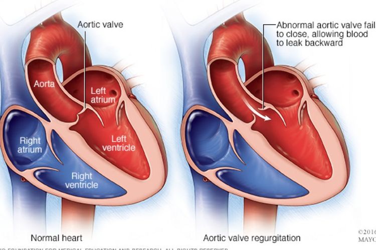 aorta