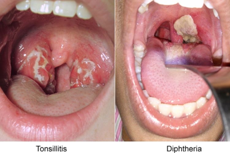 Perbedaan selaput pada difteri dan tonsilitis atau radang amandel