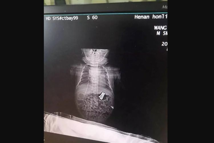 Hasil foto rontgen menunjukkan adanya tiga benda asing menyerupai sekrup di dalam perut bayi tersebut.