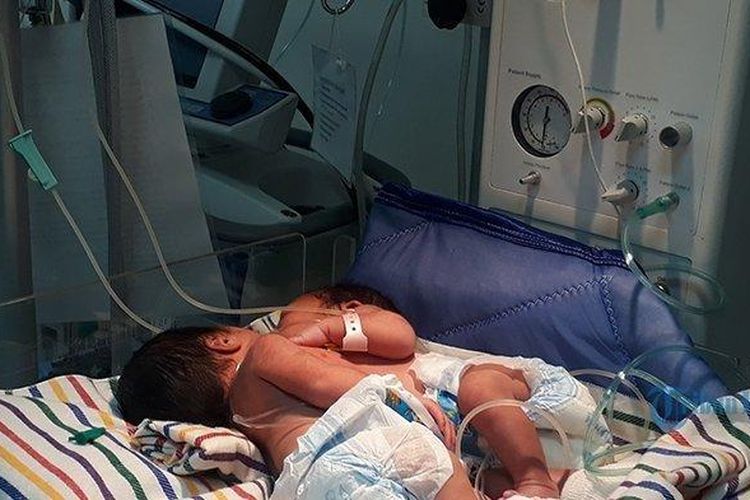 Kadek Redita (24) syok menghadapi kenyataan sang istri Putu Ayu Sumadi (18) melahirkan bayi kembar siam (tubuh berdempetan). Anak pertama ini lahir melalui bedah cesar di RS Santi Graha, Seririt, Buleleng


