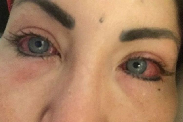 Nadinne Bruna kehilangan penglihatan setelah operasi untuk mengubah warna matanya