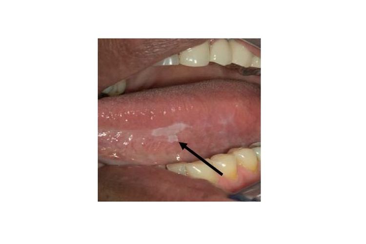 Leukoplakia