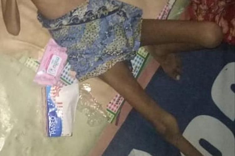 Maulana (13), penderita gizi buruk di Kampung Lio, Pancoran Mas, Depok, Minggu (7/7/2019).