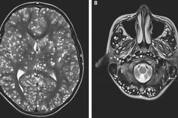 Kista penyebab kerusakan terlihat pada pemindaian MRI pada korteks serebral dan batang otak pasien.