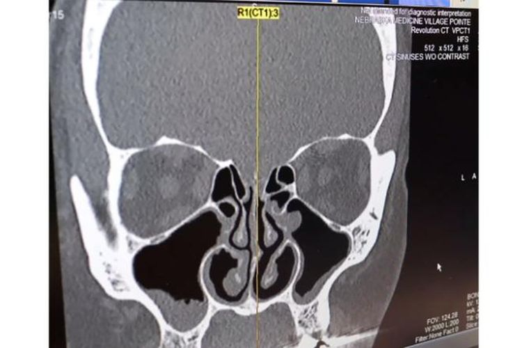 Hasil CT Scan sinus Kendra yang menunjukkan kebocoran di sisi kiri