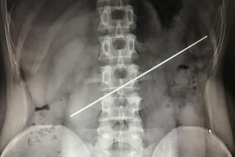 Foto rontgen yang memperlihatkan batangan besi sepanjang 20 sentimeter yang tersangkut di perut seorang pria di China.