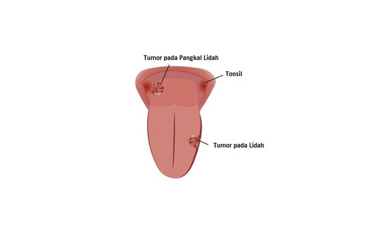 Kanker Lidah