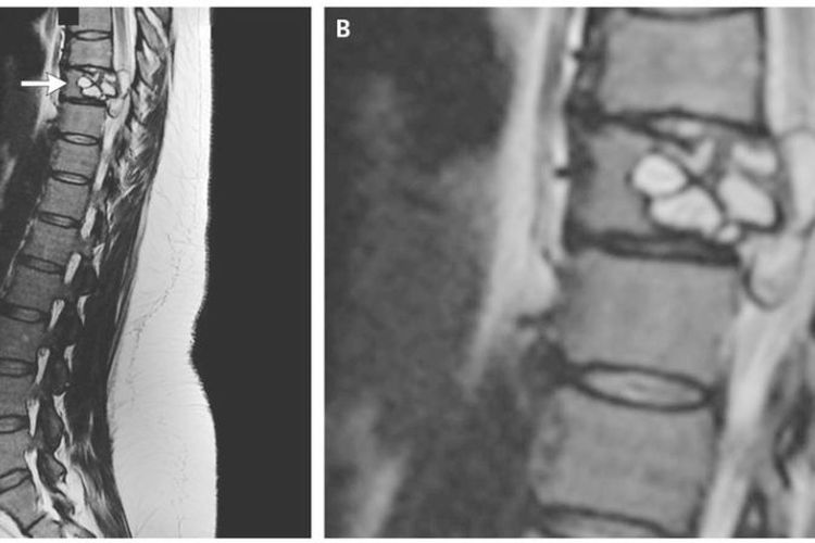 Hasil pemindaian MRI menunjukkan ada lesi berisi cacing pita di tulang belakang seorang perempuan 35 tahun asal Perancis yang membuat kakinya mati rasa dan kehilangan keseimbangan.