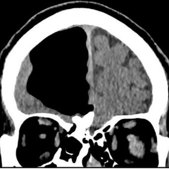 Hasil CT Scan pria 84 tahun menunjukkan rongga udara hitam yang disebut pneumatocele.