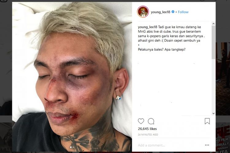 Rapper Young Lex menunjukkan wajahnya yang memar di akun Instagram-nya, @young_lex18. Ia mengaku berkelahi dengan fans K-pop.