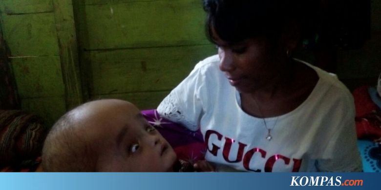 Bayi Penderita Hidrosefalus dari Kepulauan Aru Dirawat Jakarta