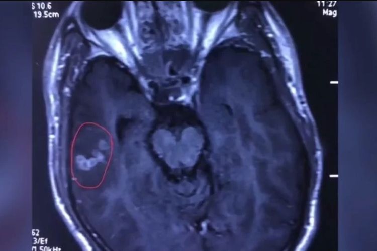 Foto pindaian sinar-x yang menunjukkan adanya obyek seperti tali di otak pasien.