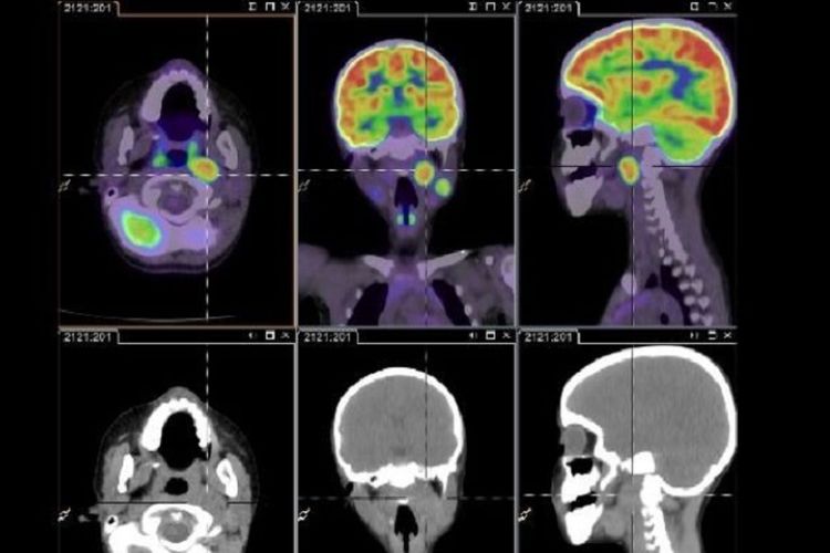 Seorang ahli bedah di Melbourne Australia menggunakan robot untuk operasi tumor langka pada anak