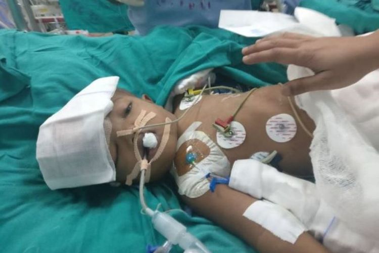 Salah satu bayi usai dilakukan operasi pemisahan dempet kepala di India.