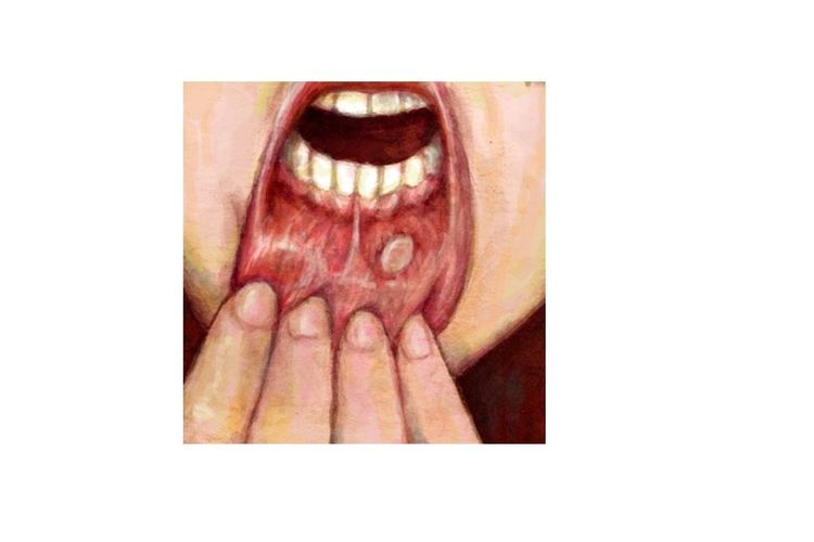 Canker Sore