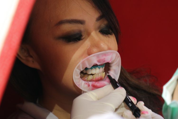 Proses pemberian lapisan pelindung gigi sebelum memulai perawatan Millionaires Smile. 