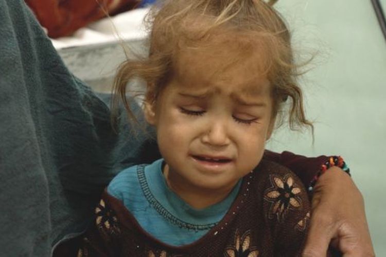 Sejumlah anak mengalami kurang gizi akibat kelaparan yang melanda Afghanistan.