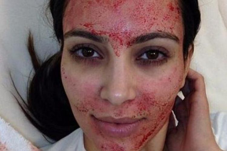 Kim Kardashian lakukan perawatan Vampire Facial