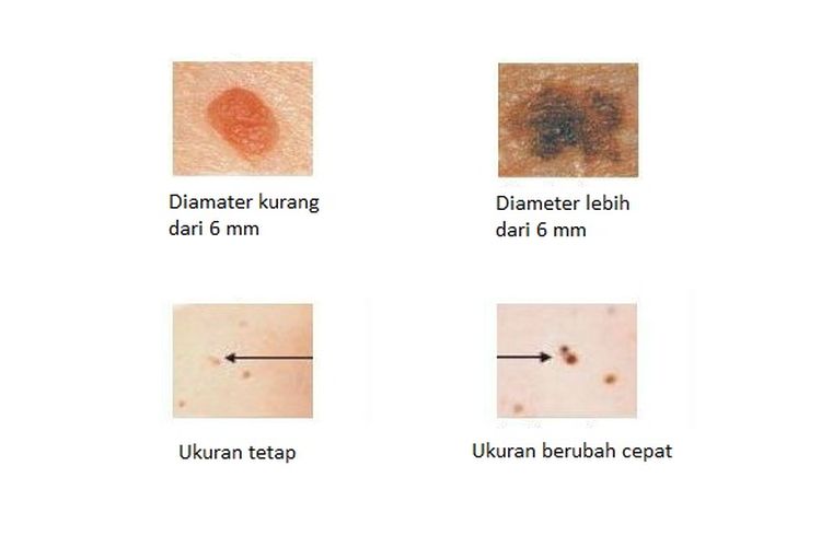 Tahi lalat tanda melanoma, ukuran berubah dan diameter lebih dari 6 mm.