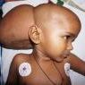 Kisah Renu, Penderita Tumor Otak Sebesar Bola Sepak di Kepala