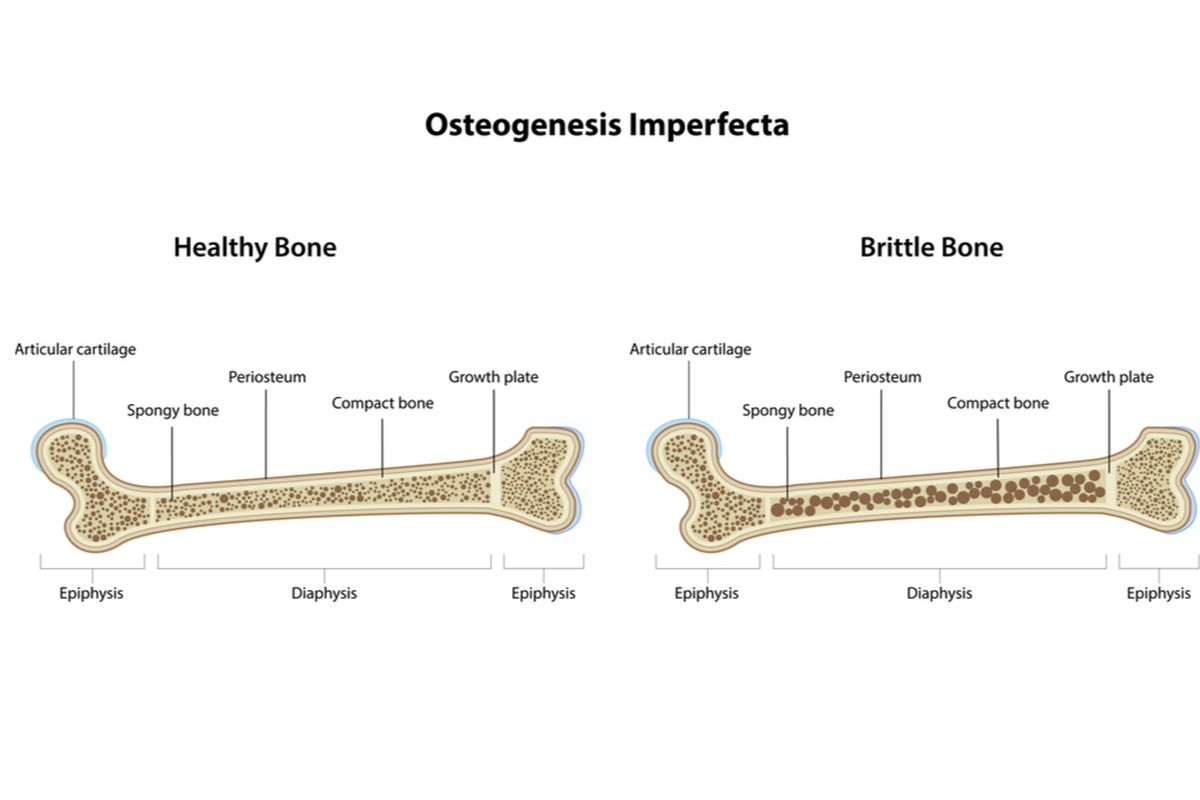 ilustrasi osteogenesis imperfecta