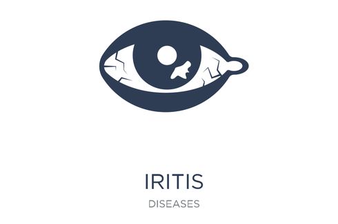 Iritis