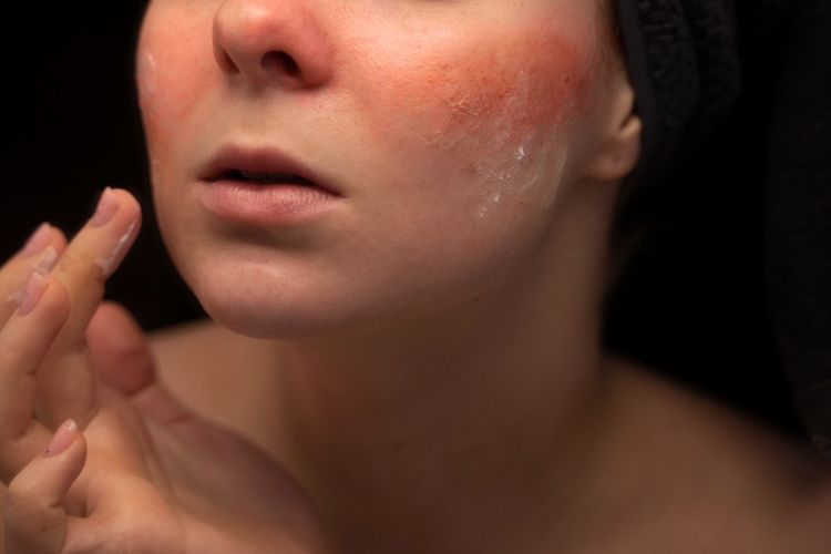 Masalah Kulit Rosacea, Apakah Bisa Diturunkan secara Genetik?
