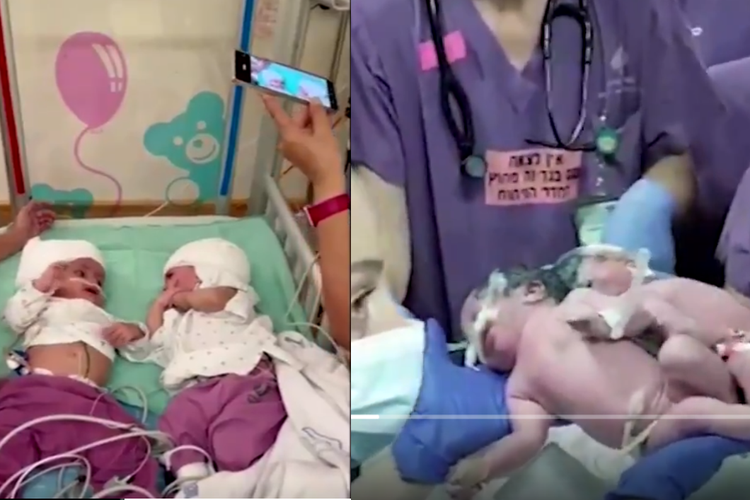 Tangkap layar gadis kembar Israel yang disatukan di bagian belakang kepala menjalani operasi pemisahan selama 12 jam dan sekarang keduanya dapat saling menatap mata.
