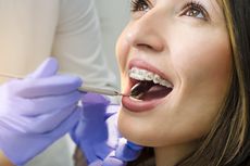 5 Cara Merapatkan Gigi yang Renggang
