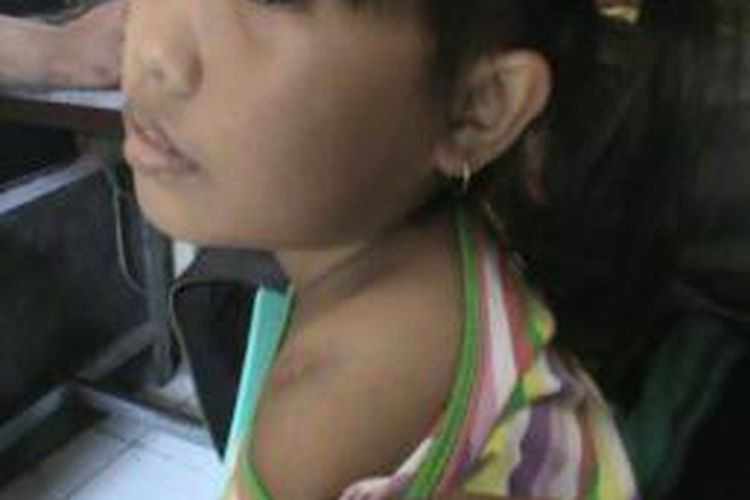 Gianinni, bocah SD korban pemukulan guru kelas saat dirawat di puskesmas di Parepare.