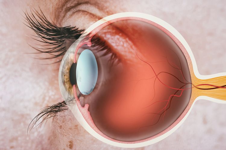 Ilustrasi diabetik retinopati yang bisa menyebabkan kebutaan