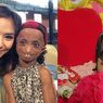 Progeria