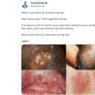 Benarkah Pakai Air Liur Saat Hubungan Seks Bisa Memicu Herpes Genital?