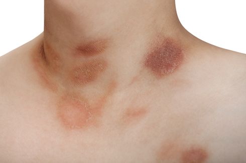 Pityriasis Rosea