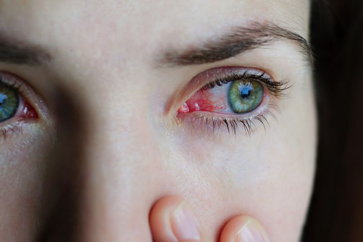 Berkedip lebih sering adalah salah satu cara mengatasi mata kering secara alami.