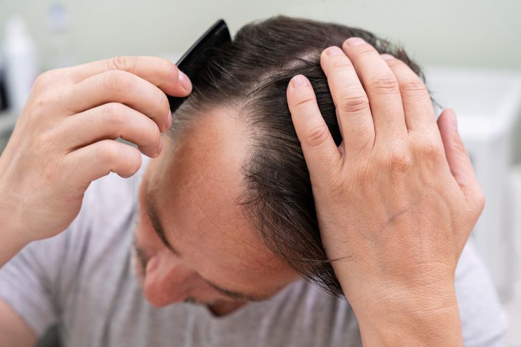 Apa saja yang harus dipersiapkan sebelum transplantasi rambut atau hair transplant? Simak penjelasan dokter berikut ini. 