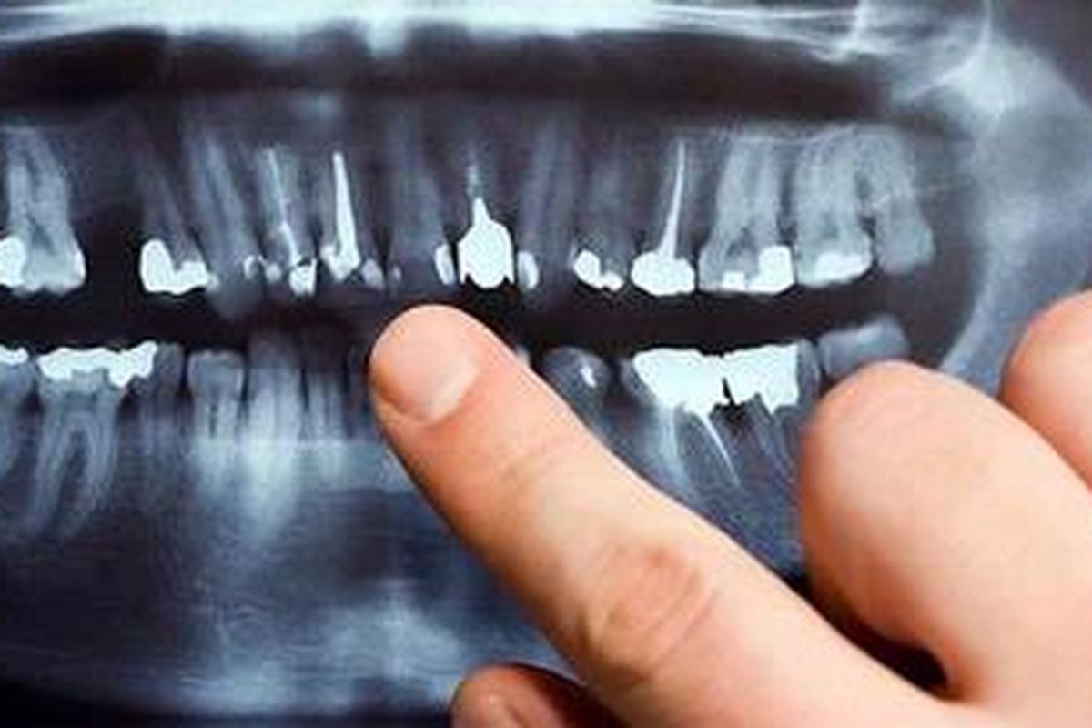 Ilustrasi rontgen gigi