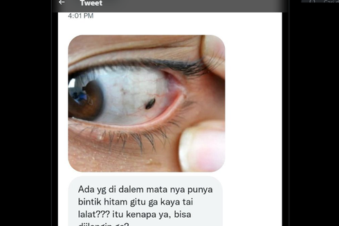 Berita Harian Muncul Bintik Hitam Di Mata Terbaru Hari Ini - Kompas.com