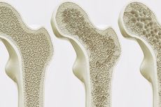 Cara Mencegah Osteoporosis yang Penting Dilakukan Sebelum Terlambat