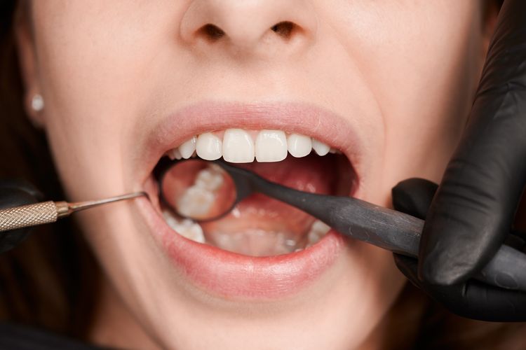 Plak Gigi Bisa Picu Penyakit Serius, Ini 5 Cara Mencegahnya
