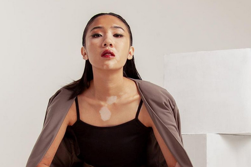 Dulu Tutupi Vitiligo Pakai Stoking dan Foundation, Zsazsa Caesar Kini Jadi Model Inspiratif