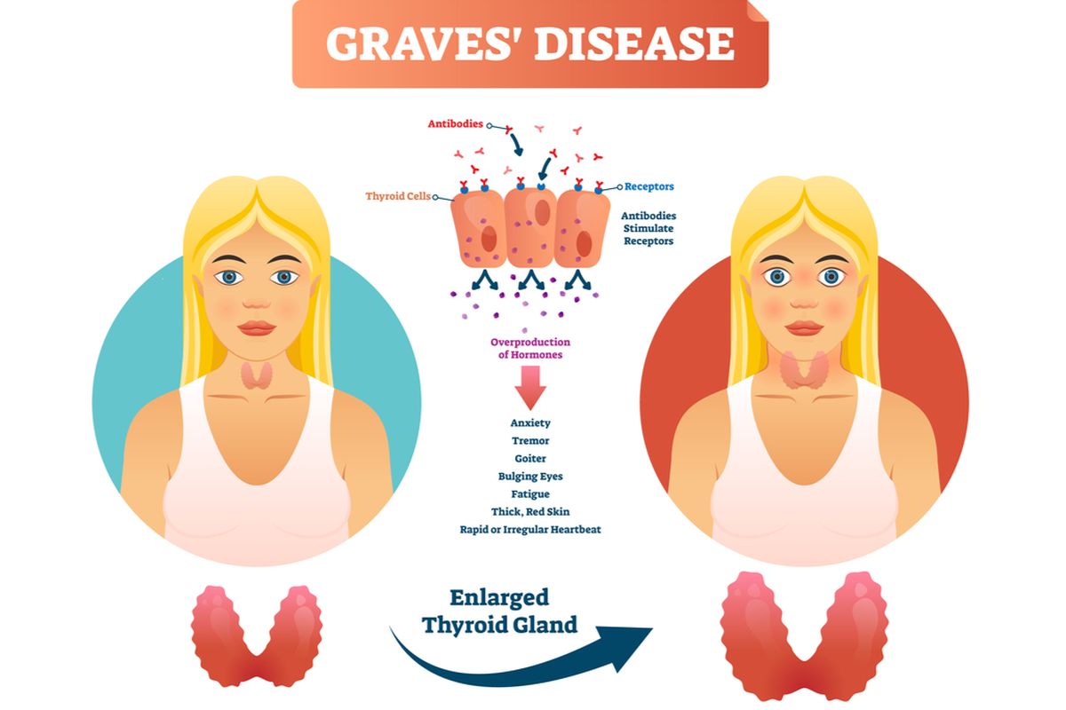 Ilustrasi Penyakit Graves