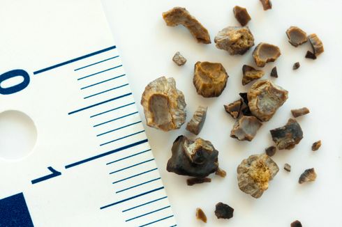 Batu Tanduk Rusa Ginjal Bikin Kencing Berdarah, Kenali Faktor Risikonya