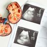 Kenapa Hipertensi Bisa Menyebabkan Gagal Ginjal?