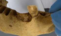 Bakteri Penyebab Gigi Berlubang Ditemukan di Geraham Berusia 4.000 Tahun
