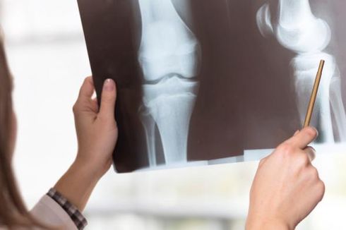 Benarkah Konsumsi Suplemen Kalsium Tak Turunkan Risiko Patah Tulang?