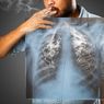 10 Cara Mencegah Kanker Paru-paru yang Penting Diketahui