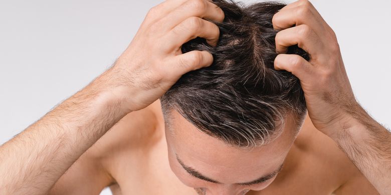 menghindari menggaruk kulit kepala juga bisa menjadi cara menghilangkan ketombe secara alami.