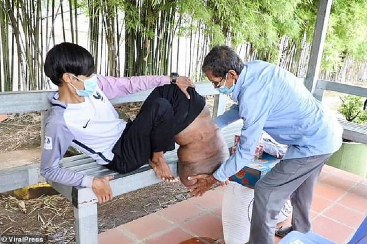 Kondisi kaki Bong Thet akibat digigit nyamuk