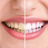 8 Tips Merawat Gigi Sehat dan Cantik